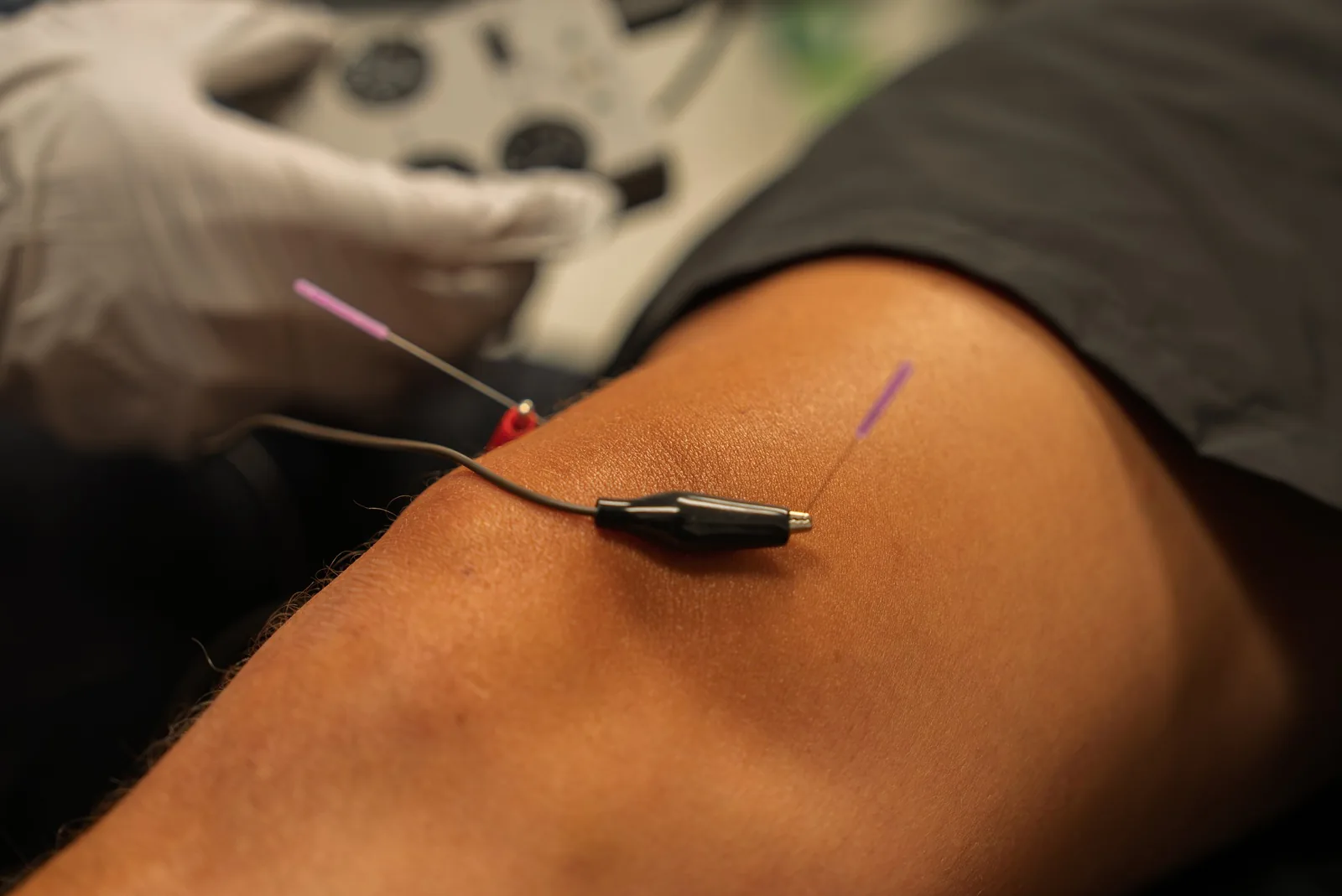 Close-up of dry needling being applied to a muscle